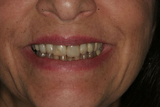 Porcelain Veneers Case 6 - Ridgewood, NJ - Before