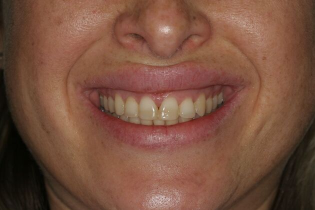 Porcelain Veneers Case 7- Ramsey, NJ - Before