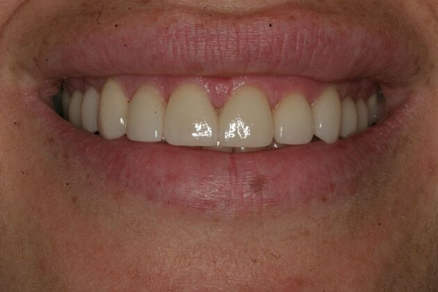Porcelain Veneers Case 7- Ramsey, NJ - After