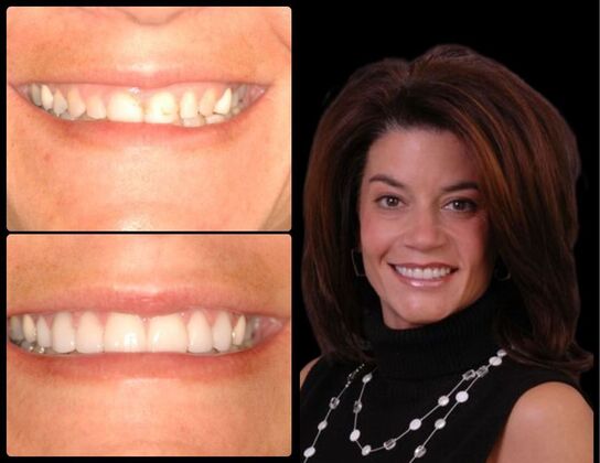 Porcelain Veneers Case 1- Ridgewood, NJ