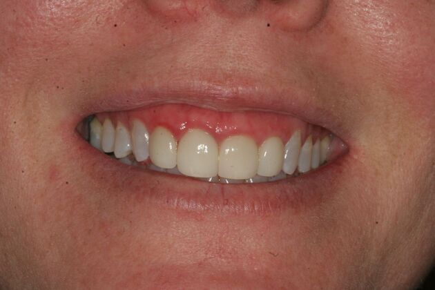 Porcelain Veneers Case 8 - Ramsey, NJ - Before