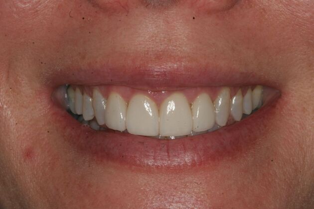 Porcelain Veneers Case 8 - Ramsey, NJ - After