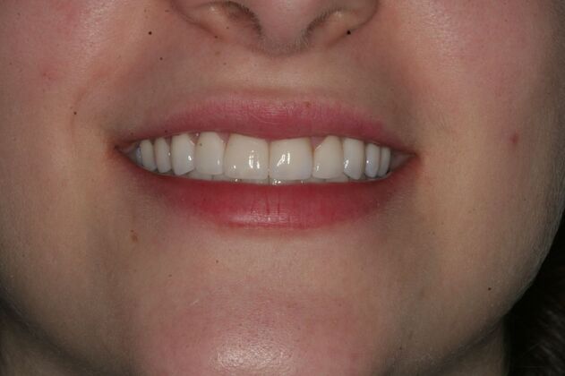 Porcelain Veneers Case 9 - Ridgewood, NJ - After
