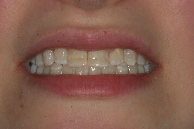 Porcelain Veneers Case 9 - Ridgewood, NJ - Before