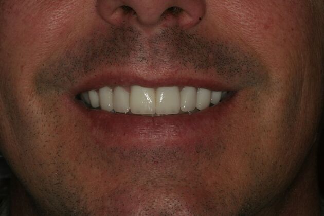 Porcelain Veneers Case 10 -Bergen County, NJ - After