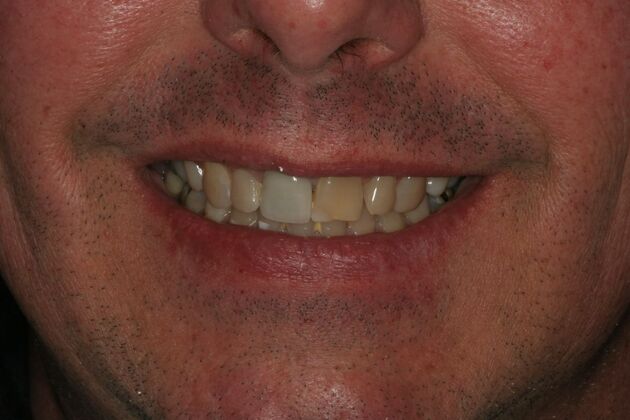 Porcelain Veneers Case 10 -Bergen County, NJ - Before