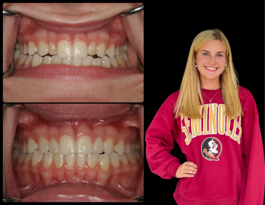 Porcelain Veneers Case 2 - Bergen County, NJ