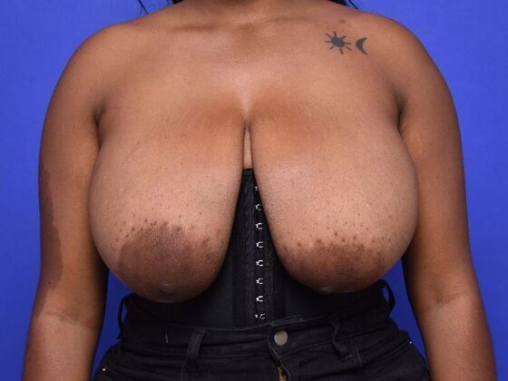 Breast Lift Case 14 - Before