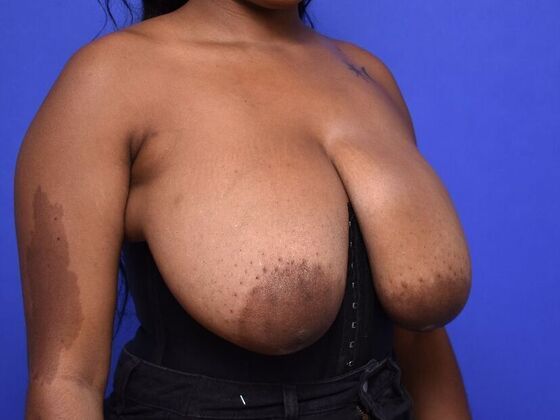 Breast Lift: Case 14 - Before
