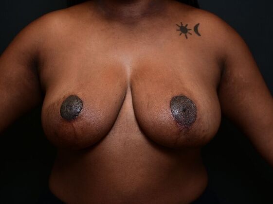 Breast Lift Case 14 - After