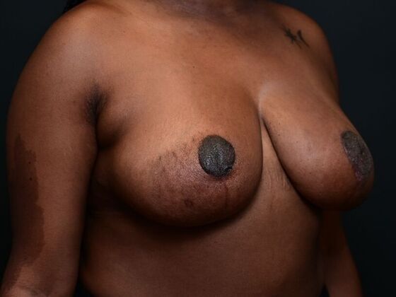 Breast Lift: Case 14 - After