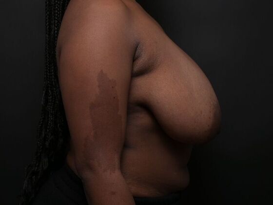 Breast Lift: Case 14 - Before