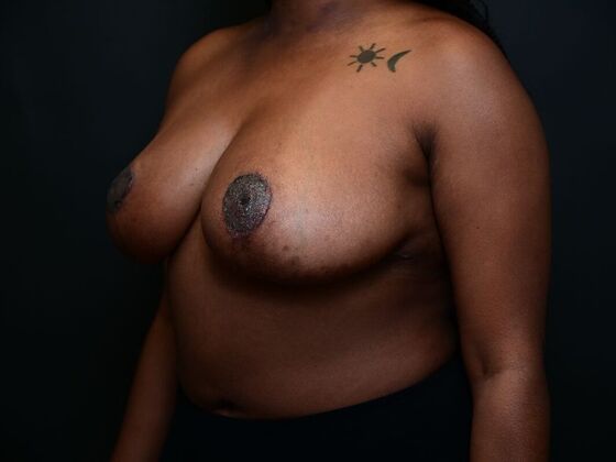 Breast Lift: Case 14 - After