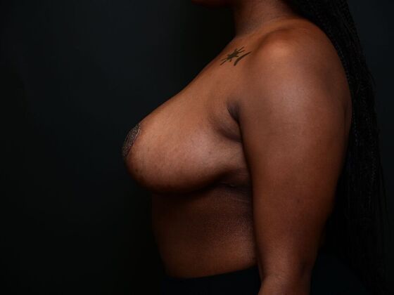 Breast Lift: Case 14 - After