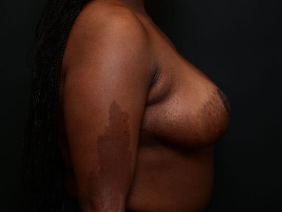 Breast Lift: Case 14 - After