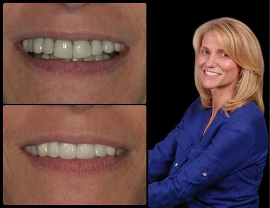 Full Mouth Reconstruction Case 1