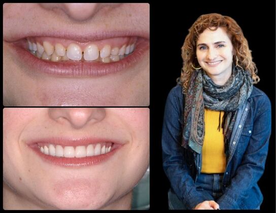 Full Mouth Reconstruction Case 2