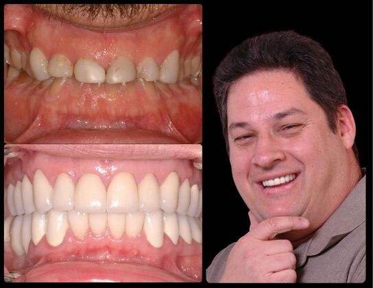 Full Mouth Reconstruction Case 5