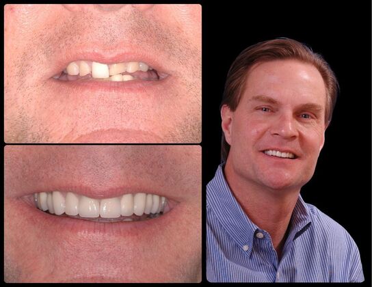 Full Mouth Reconstruction Case 4