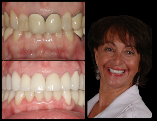 Full Mouth Reconstruction Case 8 