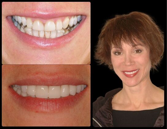 Full Mouth Reconstruction Case 3