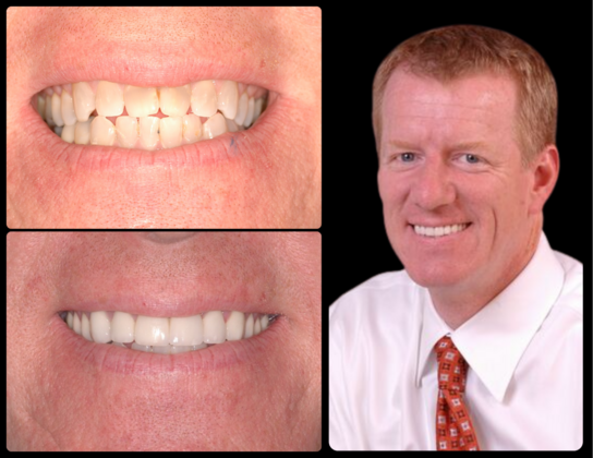Full Mouth Reconstruction Case 7 