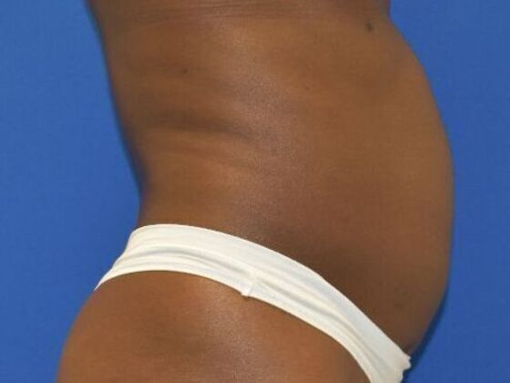 Tummy Tuck with Contouring: Case 10 - Before