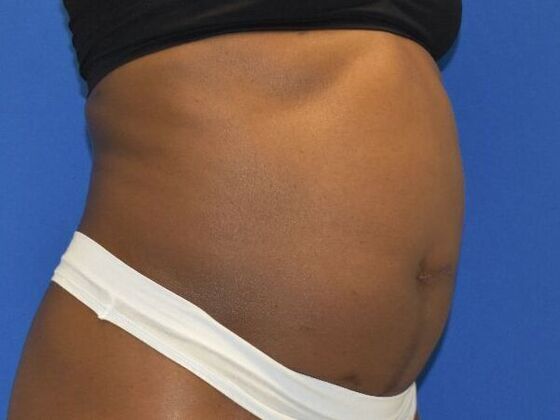 Tummy Tuck with Contouring: Case 10 - Before