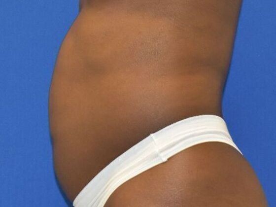 Tummy Tuck with Contouring: Case 10 - Before