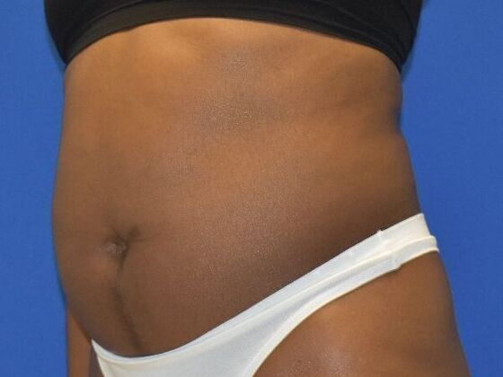 Tummy Tuck with Contouring: Case 10 - Before