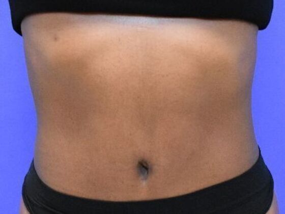 Tummy Tuck with Contouring Case 10 - After