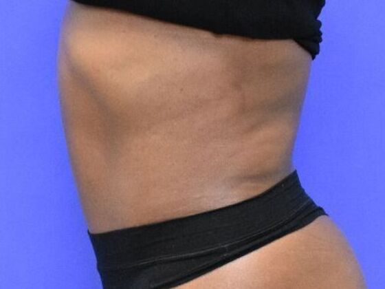 Tummy Tuck with Contouring: Case 10 - After