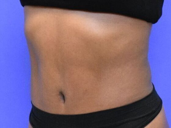 Tummy Tuck with Contouring: Case 10 - After