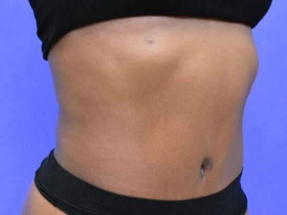 Tummy Tuck with Contouring: Case 10 - After
