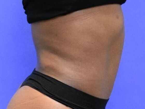 Tummy Tuck with Contouring: Case 10 - After