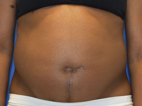 Tummy Tuck with Contouring Case 10 - Before