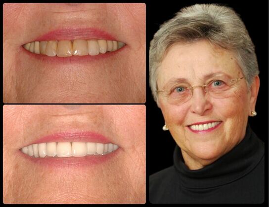 Full Mouth Reconstruction Case 6