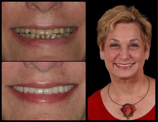 Dental Implants Case 2 - Bergen County