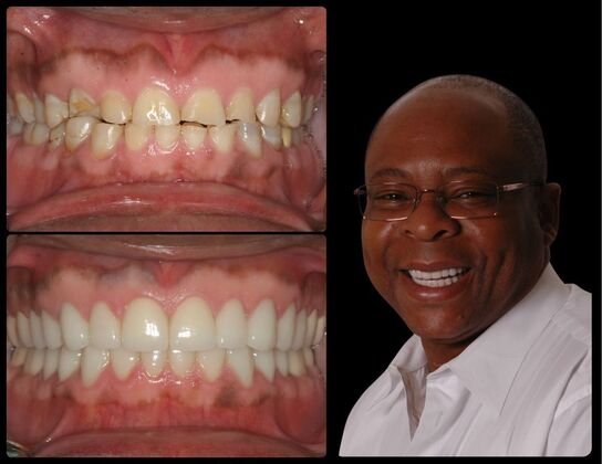            Dental Crowns Case 1- Wyckoff, NJ