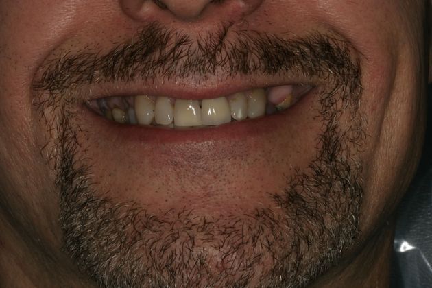            Dental Crowns Case 3 - Before