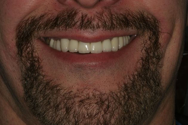            Dental Crowns Case 3 - After