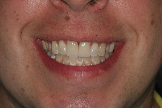            Dental Crowns Case 4 - After