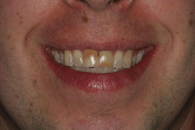            Dental Crowns Case 4 - Before