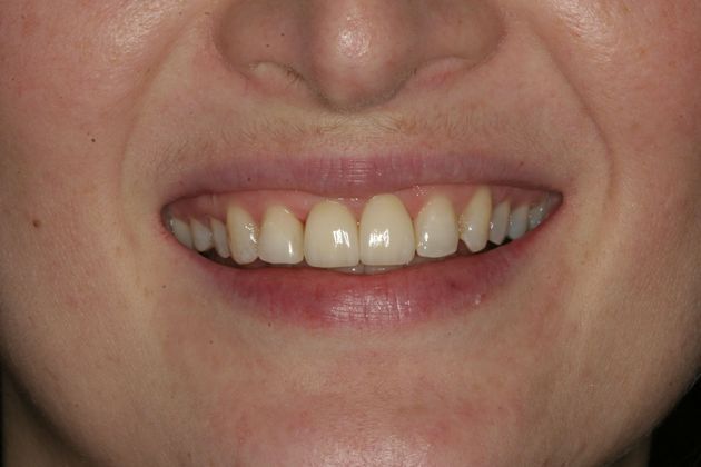            Dental Crowns Case 5 - After