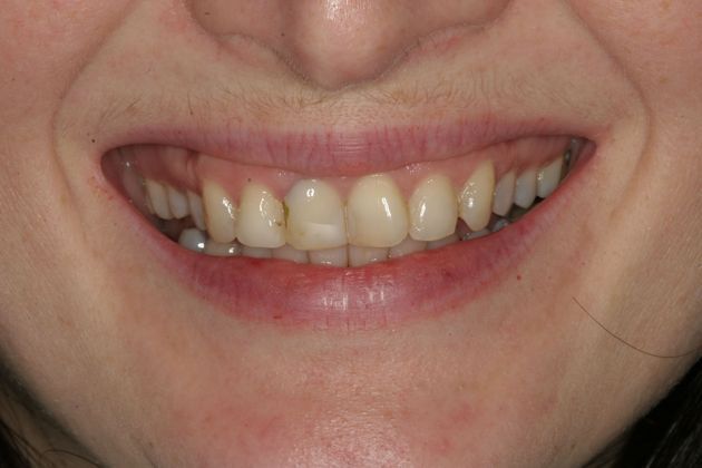            Dental Crowns Case 5 - Before