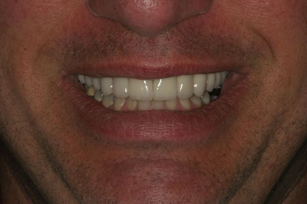            Dental Crowns Case 6 - After