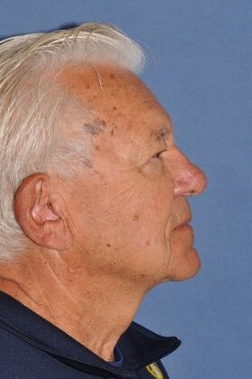 Facelift: Direct Neck Lift for turkey gobbler deformity - After