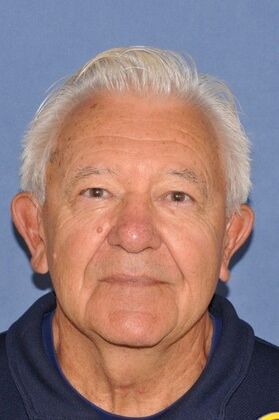 Facelift: Direct Neck Lift for turkey gobbler deformity - After