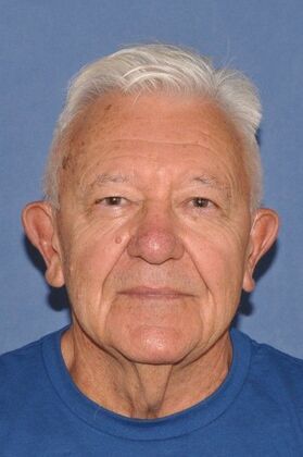 Facelift: Direct Neck Lift for turkey gobbler deformity - Before