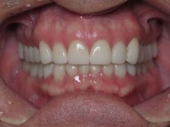 Full Mouth Rehabilitation Case 3 - After